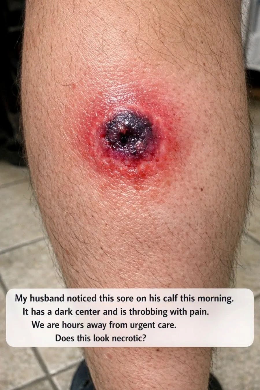 My husband noticed this sore on his calf this morning. It has a dark center and is throbbing with pain. We are hours away from urgent care. Does this . Full article 👇 💬