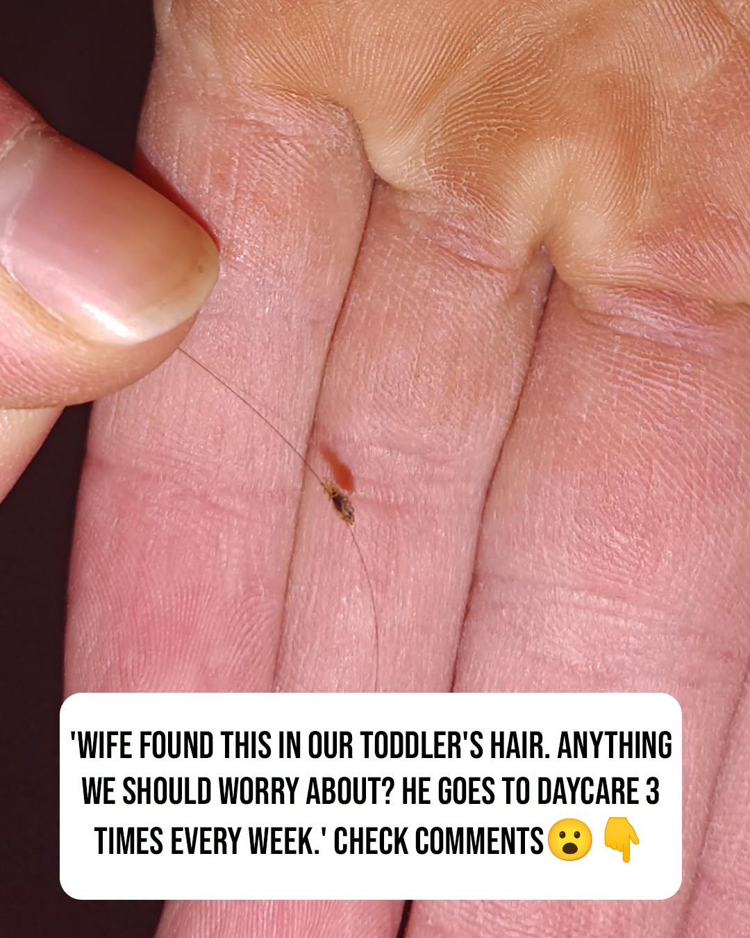 ”Wife found this in our toddler’s hair. Anything we should worry about? He goes to daycare 3 times a week.😳 check the first c0mment👇”