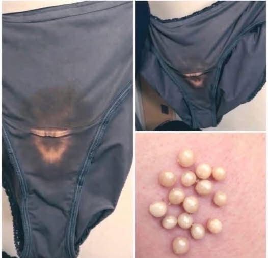 BE CAREFUL, if you notice this in your underwear, it means you have…see below