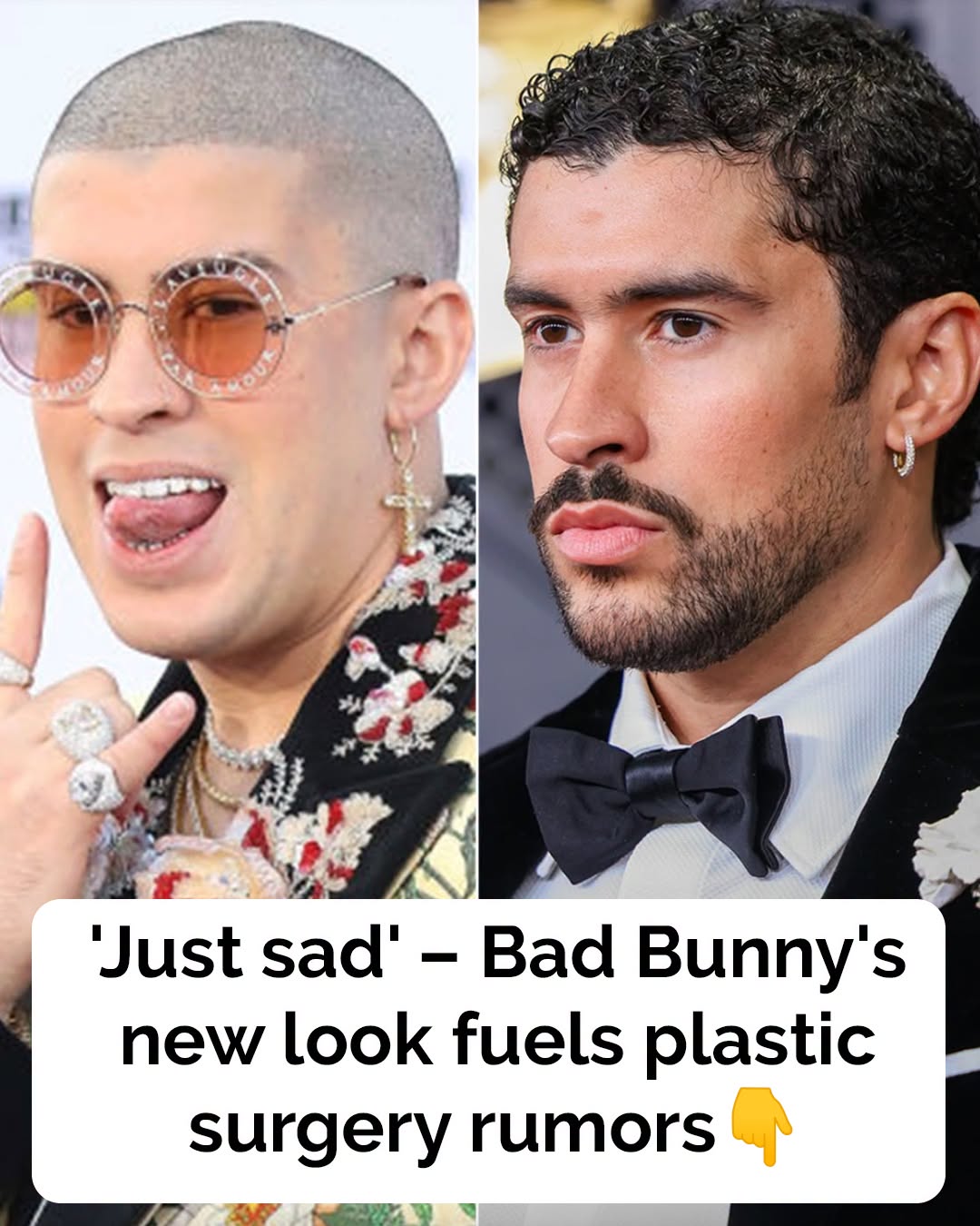 Bad Bunny sparks plastic surgery rumors after his massive physical transformation goes viral following historic Grammy win 👇🏻
