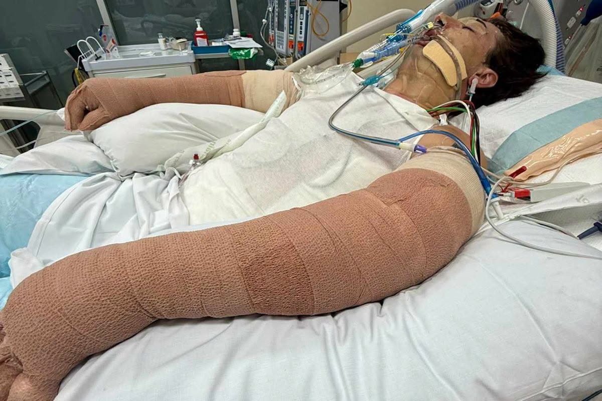 Robot Vacuum Explosion Leaves 25-Year-Old Man Critically Injured with 75% of His Body Covered in Burns… See more
