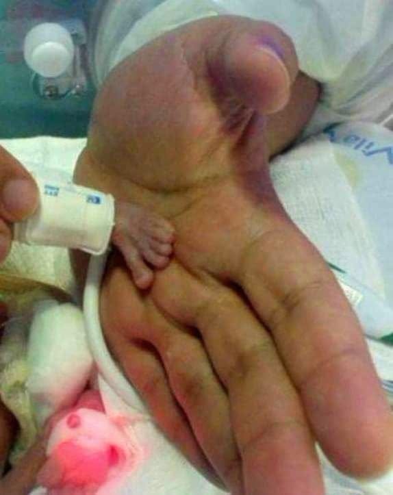 One of the smallest babies in the world was born! He was born after only 24 weeks of pregnancy. Here’s how the little one looks and how much he weighs: – Check the comments